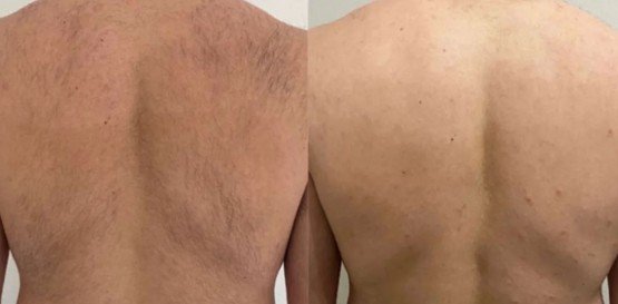 Rücken vor und nach der dauerhaften Haarentfernung