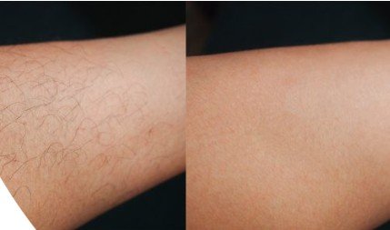 Bein vor und nach der dauerhaften Haarentfernung